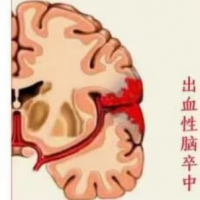 世界卒中日丨提前发现“卒”丝马迹
