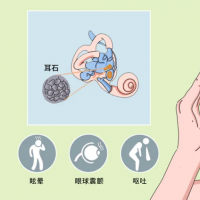 有一种头晕叫“耳石症”，符合四个特征要警惕