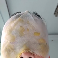 女子模仿网络“妙招”，白糖加白醋烧开除水垢致瞬间爆炸！紧急提醒→