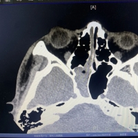 大学生鼻塞久治不愈，竟因鼻子深处藏“污水渠”？医生：此病隐蔽易误诊